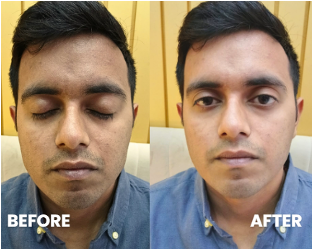 Glutathione & Vitamin C Radiance IV Drip — before and after, real client result